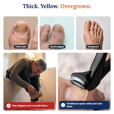 TrimReach: Thick nails problem